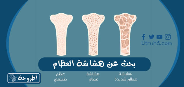 بحث عن هشاشة العظام