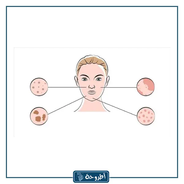 علاج الكلف أثناء الحمل