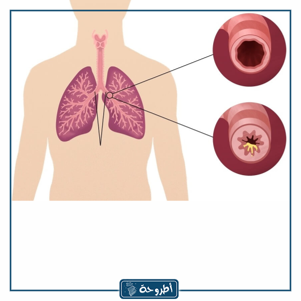 حكم بلع البلغم في الصيام